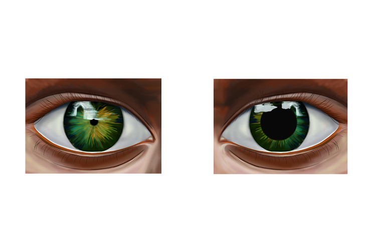 Image showing one pupil at its normal light position and one at its dilated position in low light